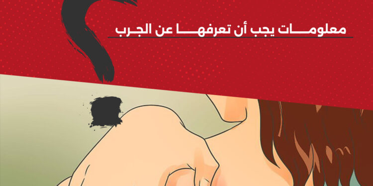 معلومات يجب أن تعرفها عن الجرب